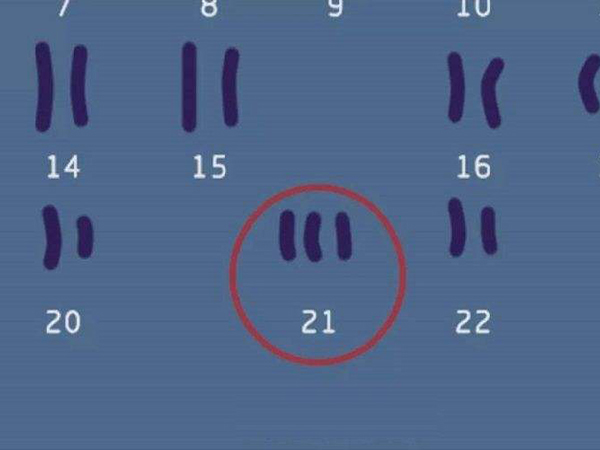 21號染色體異常一般無法治療