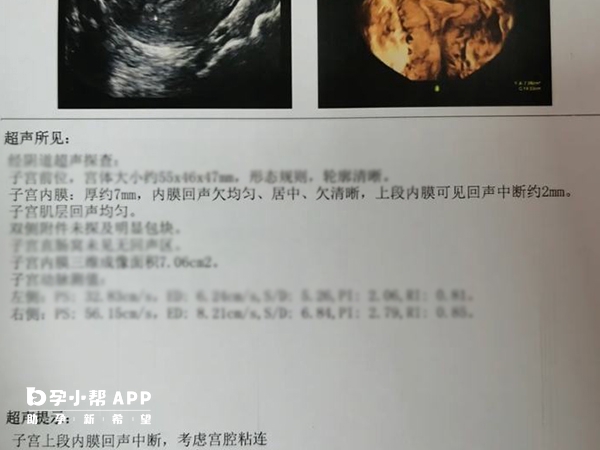 內膜中斷可能是宮腔粘連