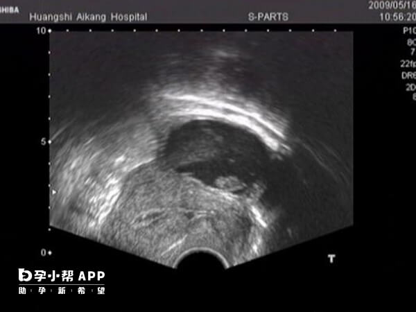 宮腔粘連嚴重會破壞內膜