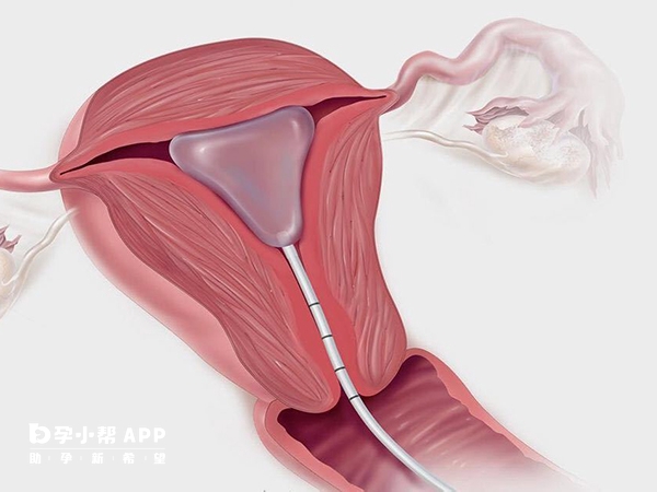 发现宫腔粘连要及时做手术治疗