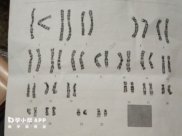 9号染色体异常可能会导致不良妊娠结果