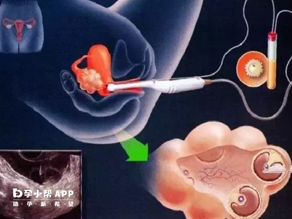 微刺激方案能取2-3个卵子