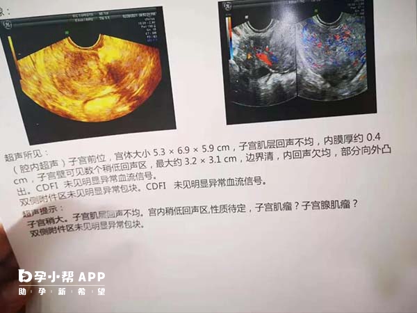 腺肌症做三代試管成功率高