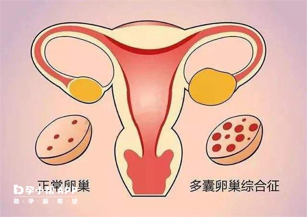 拮抗剂方案适合多囊卵巢综合征患者