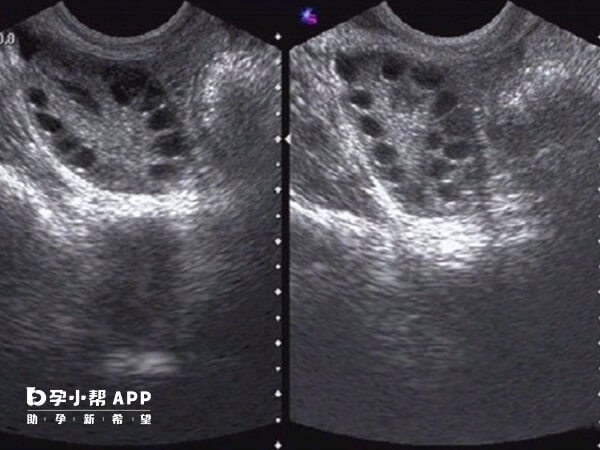 轻症多囊卵巢（PCOS）做几代试管婴儿移植更容易怀上？