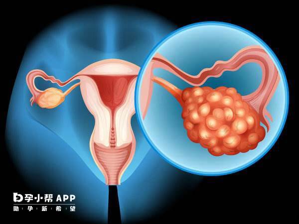 多囊卵巢综合症与内分泌失调有一定关系