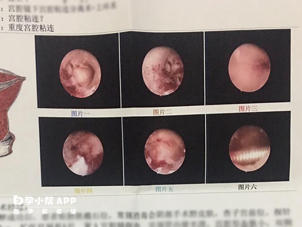 重度宮腔粘連b超報告單