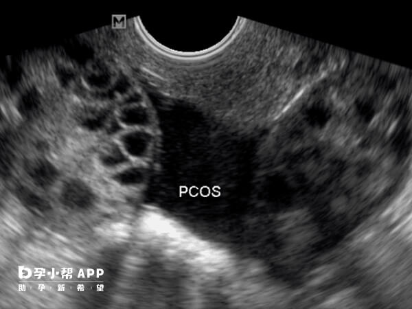 多囊卵巢综合征是一种生殖内分泌代谢性疾病