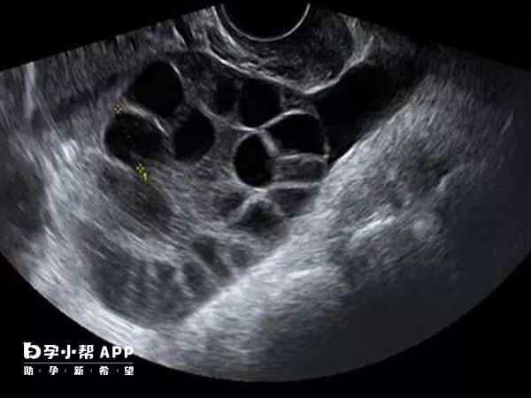 12个窦卵泡在正常范围内