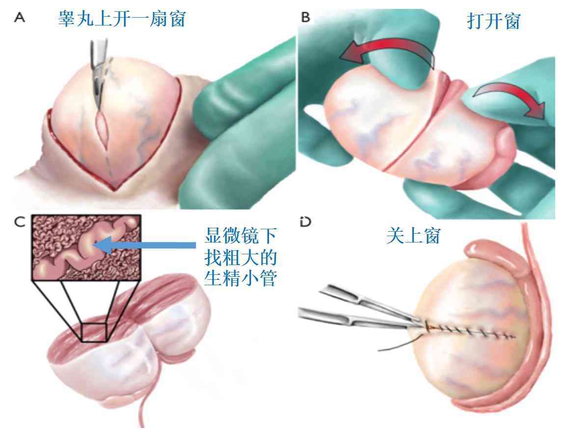 顯微取精