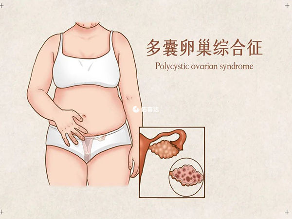 多囊卵巢综合征（PCOS）