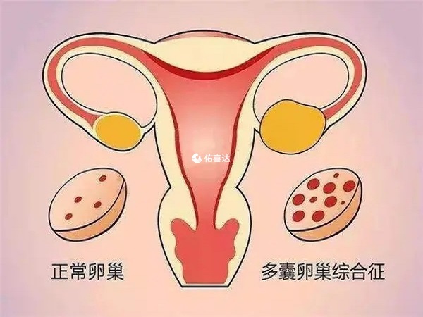 多囊需要選擇對卵巢刺激小的促排方案