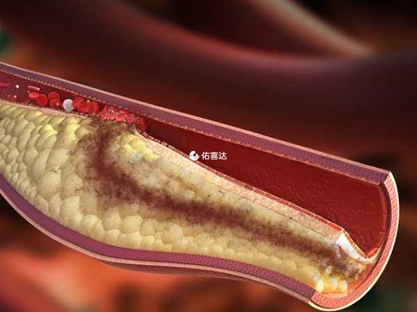 动脉硬化最主要的就是软化血管