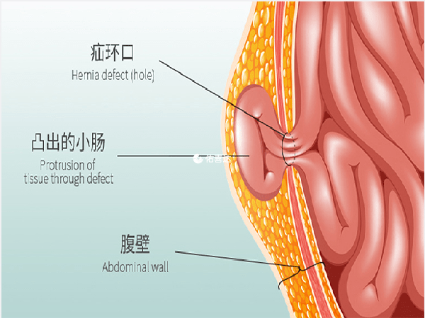 疝气不严重的患者可以通过饮食治疗