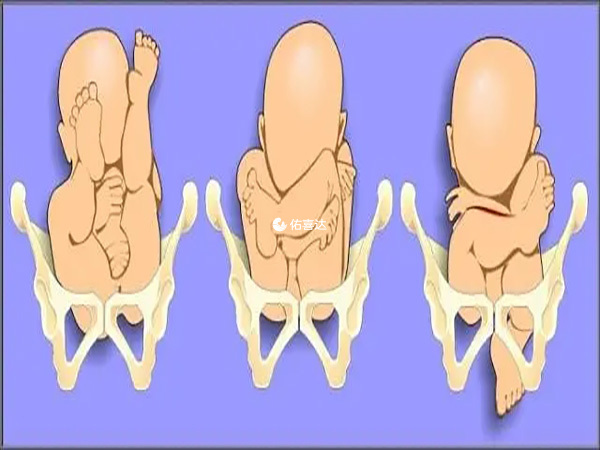 胎儿臀位的纠正方法