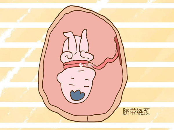 臍帶繞頸的3種睡姿推薦