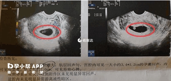 茄子形孕囊图片