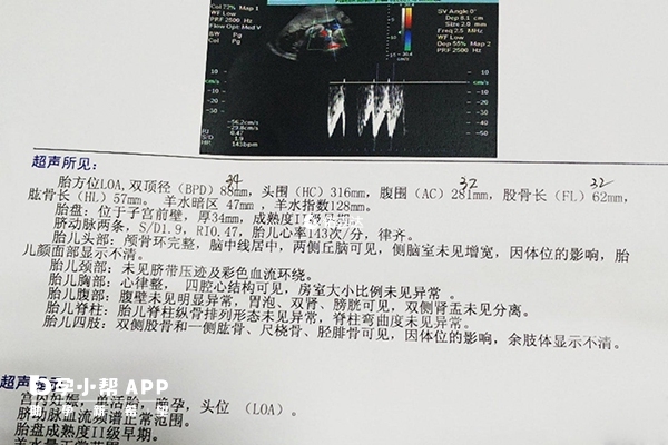 B超檢查單包括雙頂徑結果資料