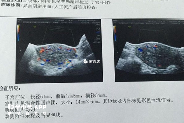 血块在B超检查中的图像