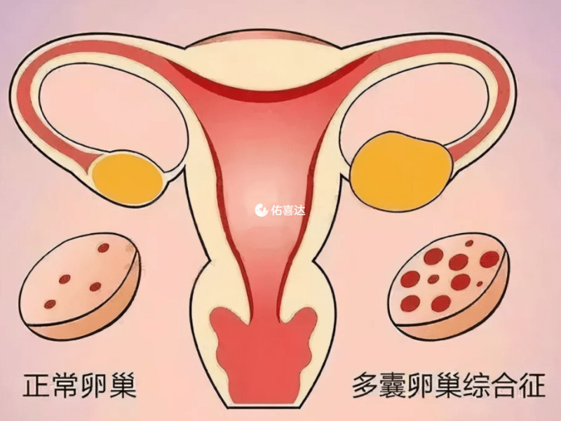 跳绳利于改善多囊卵巢综合征