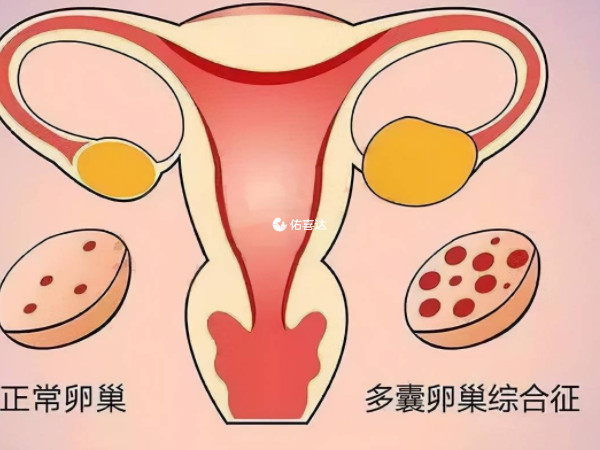 肌醇膽鹼用於治療多囊卵巢綜合症