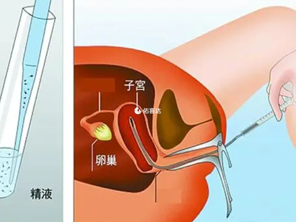 人工受孕分為人工授精和試管嬰兒