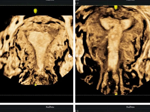 二维彩超和三维彩超各有各的优势