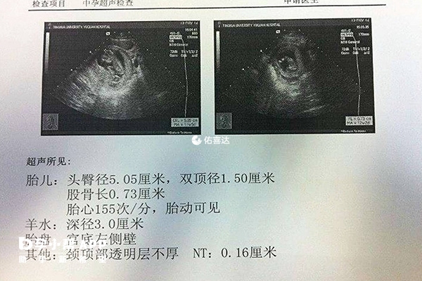 B超檢查單看孕囊大小可預測男女