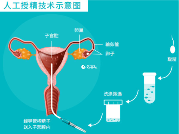 駐馬店單週期人工授精費用4000-5000元