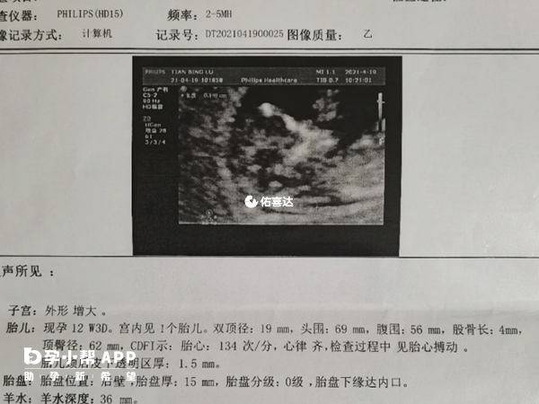 NT检查并不能知晓胎儿性别