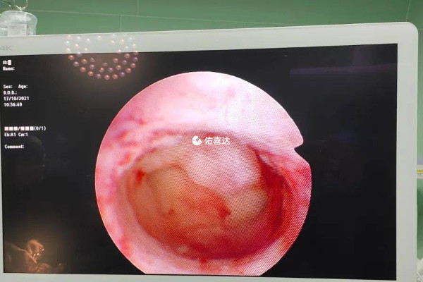 宫腔粘连做宫腔镜后需尽快怀孕