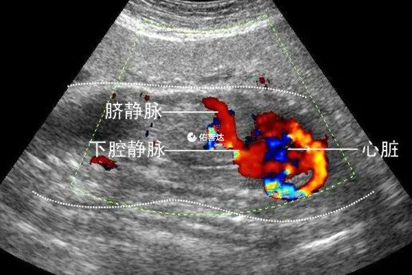 四维彩超可观察胎儿动态变化