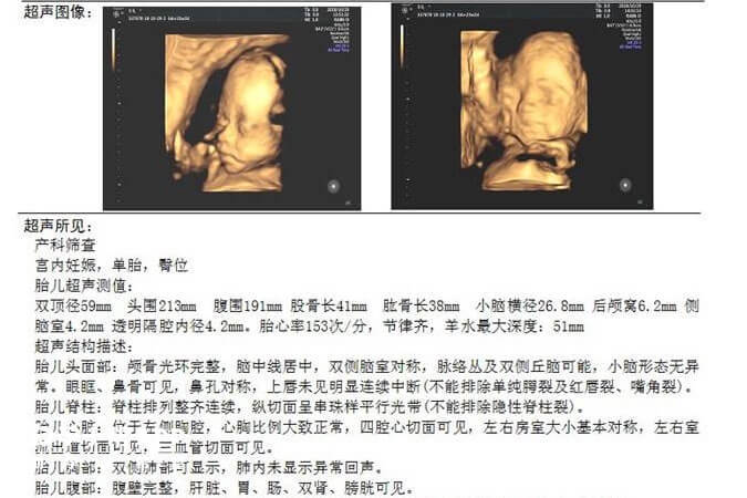 通过彩超单数据推测胎儿性别