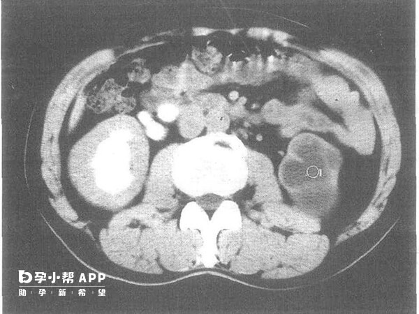 腎盂擴張小於4mm都是正常胎兒