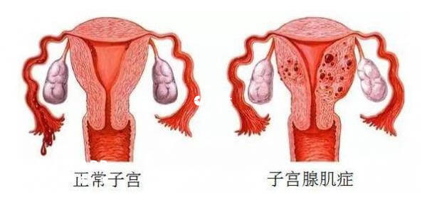 正常子宮與子宮腺肌症對比圖