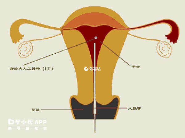 輸卵管通暢可以直接做人工授精