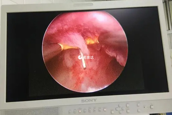 做预移植和宫腔镜不能帮助受孕