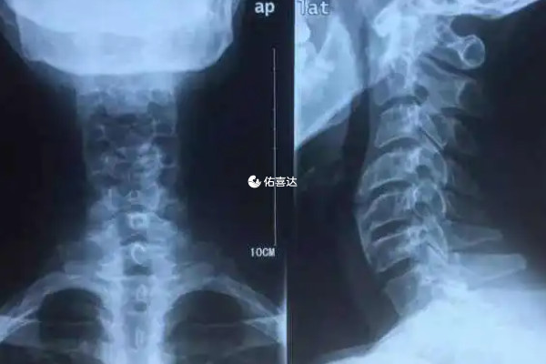 廚師體檢要檢查頸腰椎正側位