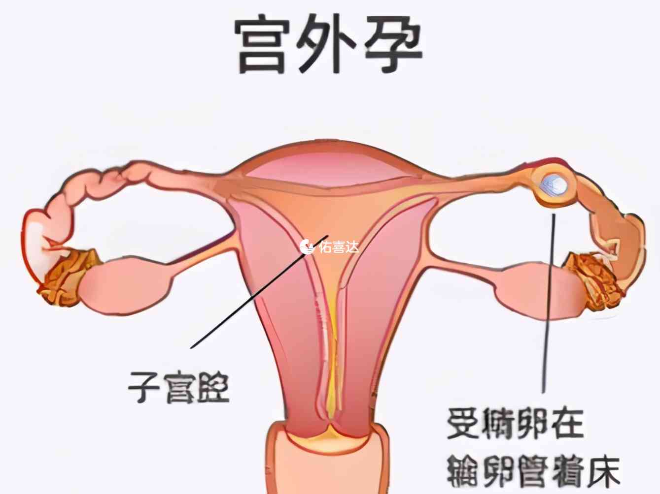 宫外孕也会出现hcg值偏低