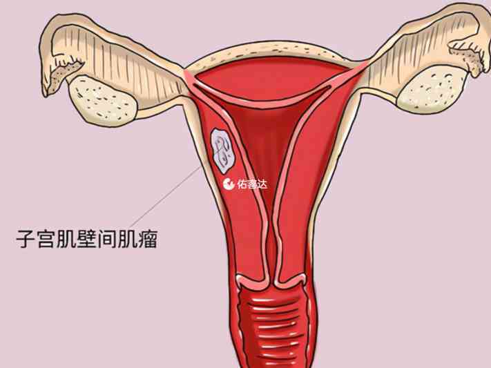 子宫腺肌症的危害