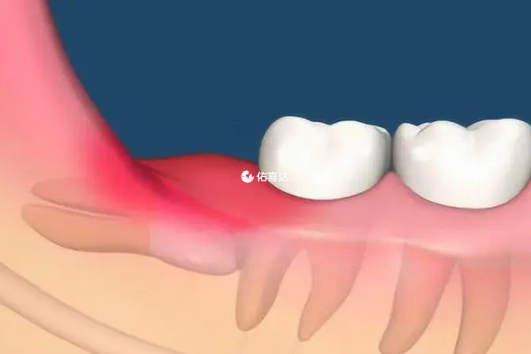藏在肉里面的智齿无需拔掉