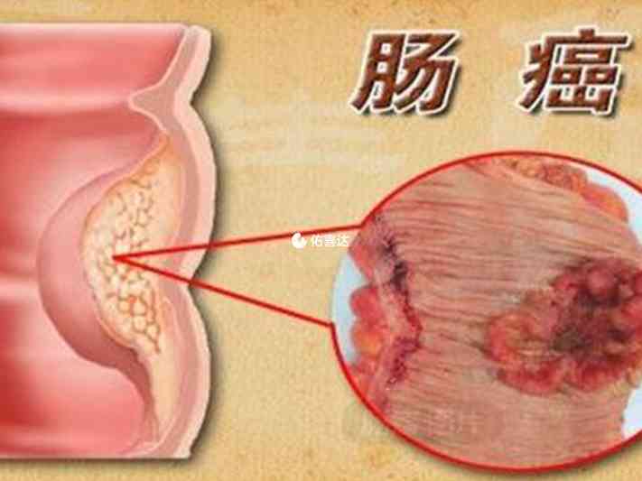 1分鐘瞭解腸癌明顯訊號