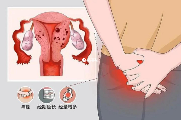 子宫腺肌症症状和试管助孕情况说明