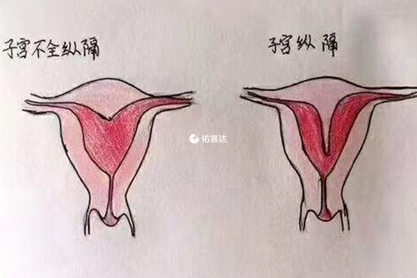 宫内环境好是不完全纵膈子宫试管条件之一