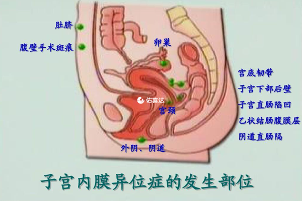 内膜异位症3期治疗方法及费用整理