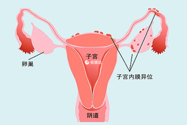 子宫内膜异位症自怀率及助孕方式分享