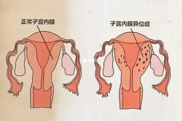 經常肚子疼是內異症典型症狀