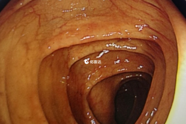 无痛肠镜检查的准确率不高