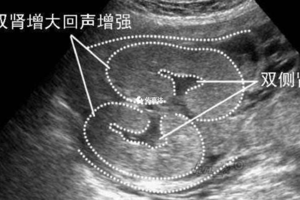 寶寶腎盂分離的自愈率有40%